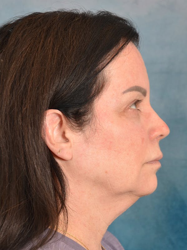 Brow Lift Before & After Gallery - Patient 307627 - Image 9