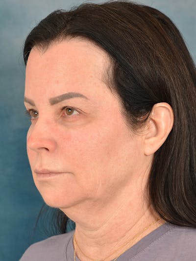 Deep Plane Facelift Before & After Gallery - Patient 178364 - Image 1