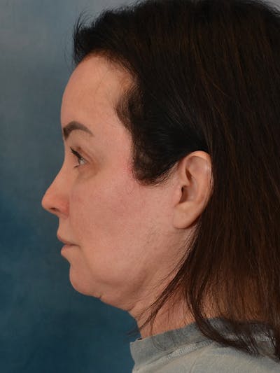 Brow Lift Before & After Gallery - Patient 307627 - Image 6