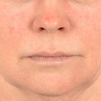 Lip Lift Before & After Gallery - Patient 190395 - Image 1