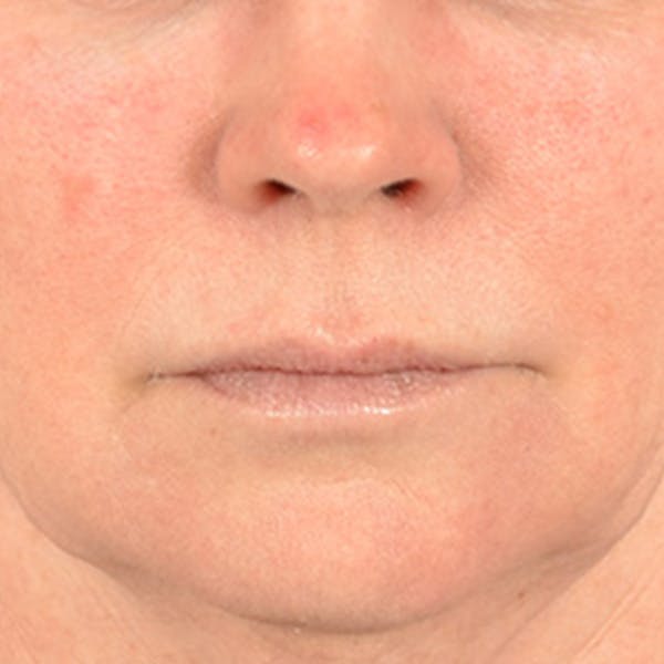 Lip Lift Before & After Gallery - Patient 190395 - Image 1