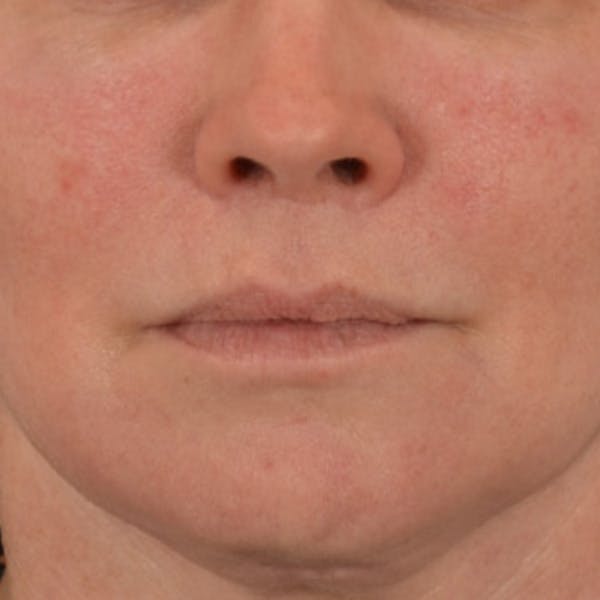 Lip Lift Before & After Gallery - Patient 190395 - Image 2