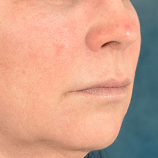 Lip Lift Before & After Gallery - Patient 190395 - Image 3
