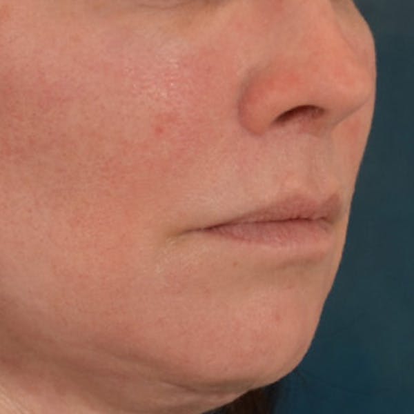 Lip Lift Before & After Gallery - Patient 190395 - Image 4