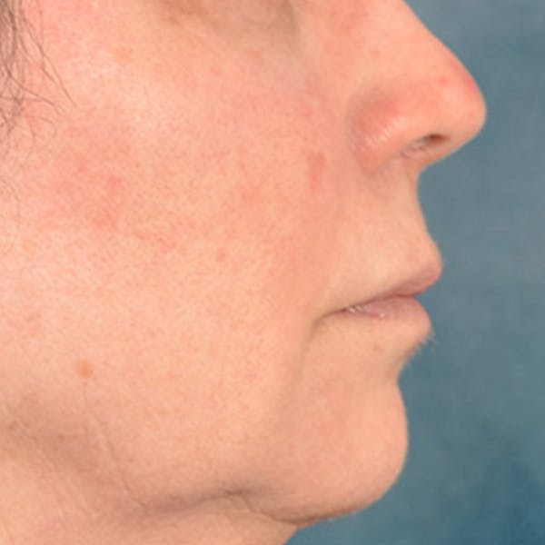 Lip Lift Before & After Gallery - Patient 190395 - Image 5