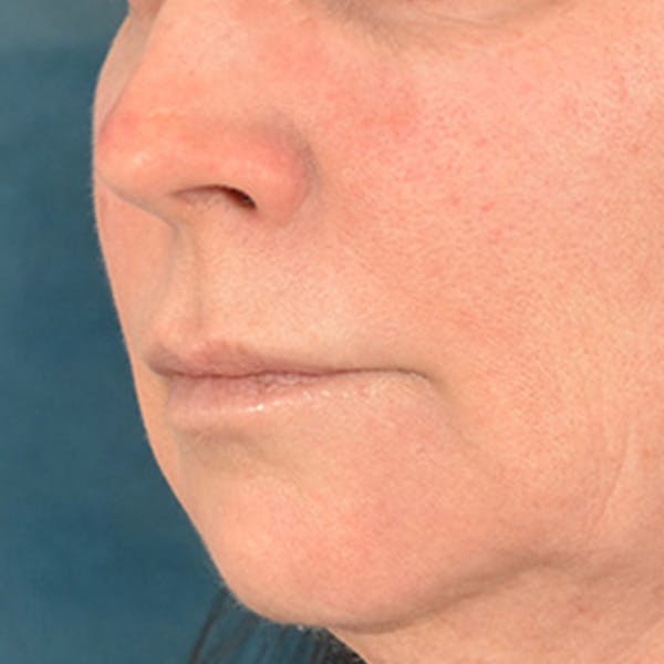 Lip Lift Before & After Gallery - Patient 190395 - Image 7