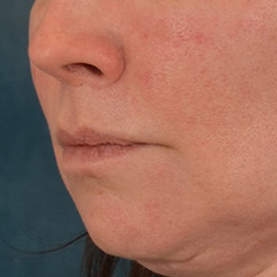 Lip Lift Before & After Gallery - Patient 190395 - Image 8