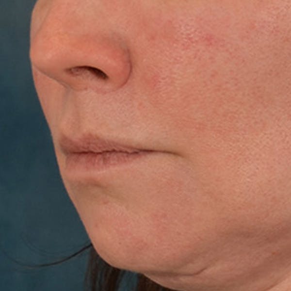 Lip Lift Before & After Gallery - Patient 190395 - Image 8