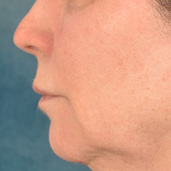 Lip Lift Before & After Gallery - Patient 190395 - Image 9