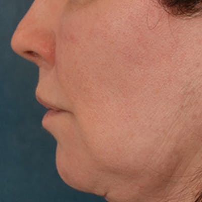 Lip Lift Before & After Gallery - Patient 190395 - Image 10