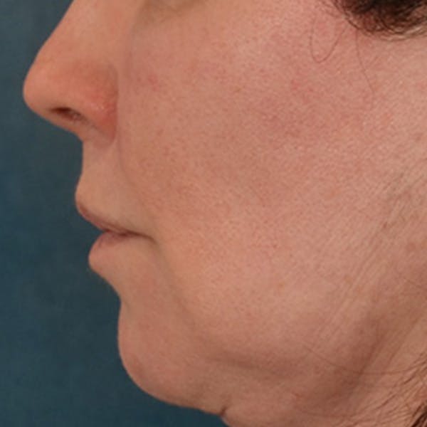 Lip Lift Before & After Gallery - Patient 190395 - Image 10