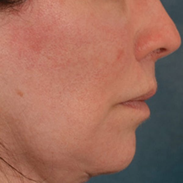 Lip Lift Before & After Gallery - Patient 190395 - Image 6