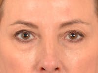 Eyelid Lift Before & After Gallery - Patient 431275 - Image 1