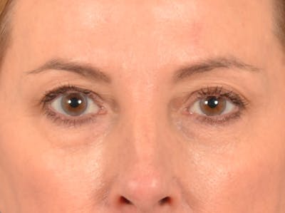 Eyelid Lift Before & After Gallery - Patient 431275 - Image 1