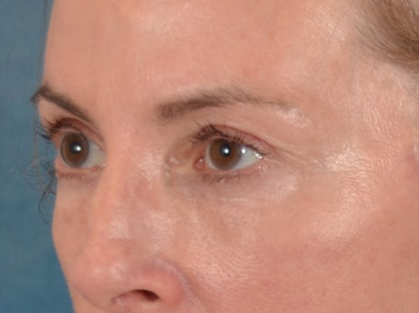 Eyelid Lift Before & After Gallery - Patient 431275 - Image 8