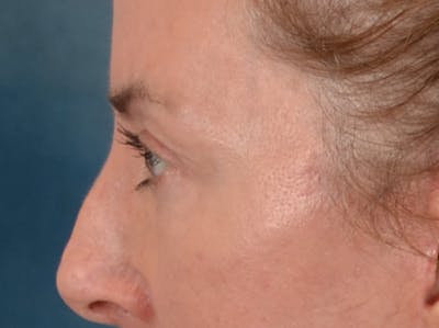 Eyelid Lift Before & After Gallery - Patient 431275 - Image 10
