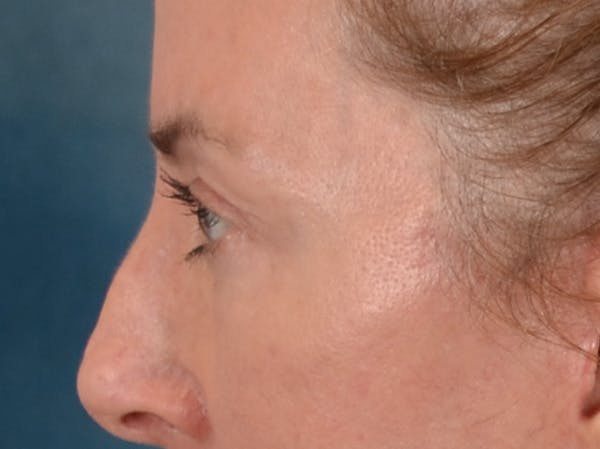 Eyelid Lift Before & After Gallery - Patient 431275 - Image 10