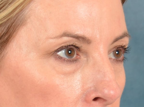 Eyelid Lift Before & After Gallery - Patient 431275 - Image 3