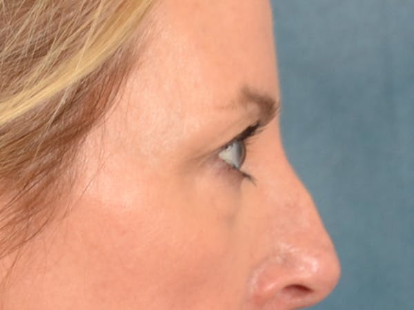 Eyelid Lift Before & After Gallery - Patient 431275 - Image 5