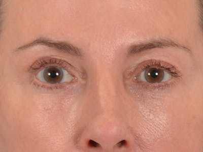 Eyelid Lift Before & After Gallery - Patient 431275 - Image 2