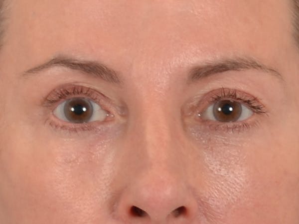 Eyelid Lift Before & After Gallery - Patient 431275 - Image 2