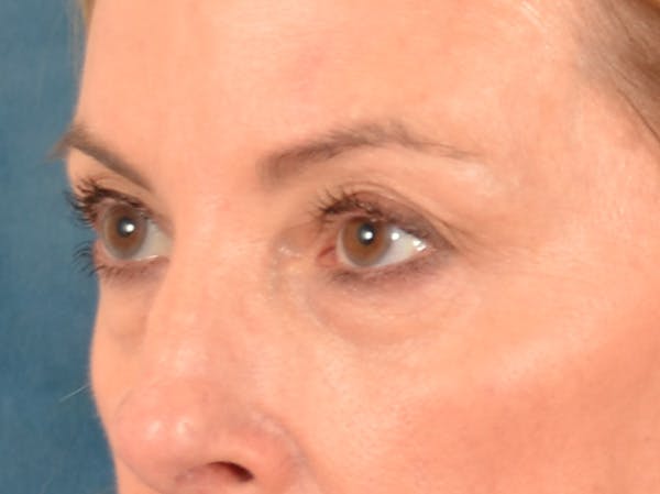 Eyelid Lift Before & After Gallery - Patient 431275 - Image 7