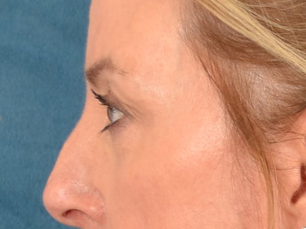 Eyelid Lift Before & After Gallery - Patient 431275 - Image 9