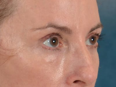Eyelid Lift Before & After Gallery - Patient 431275 - Image 4