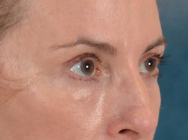 Eyelid Lift Before & After Gallery - Patient 431275 - Image 4