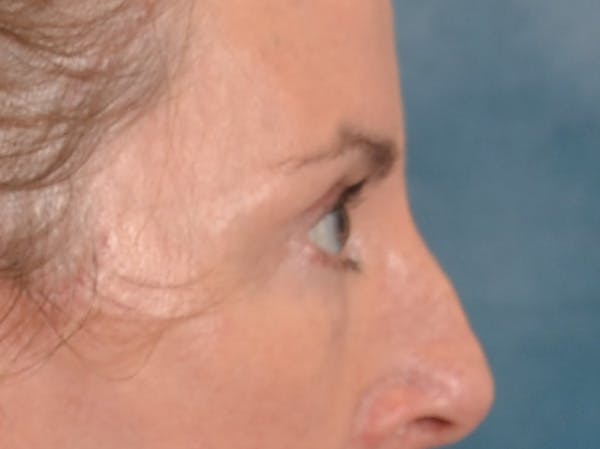 Eyelid Lift Before & After Gallery - Patient 431275 - Image 6