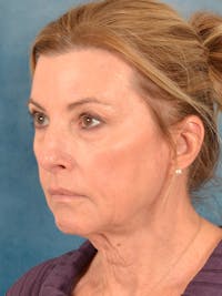 Deep Plane Facelift Before & After Gallery - Patient 980485 - Image 1