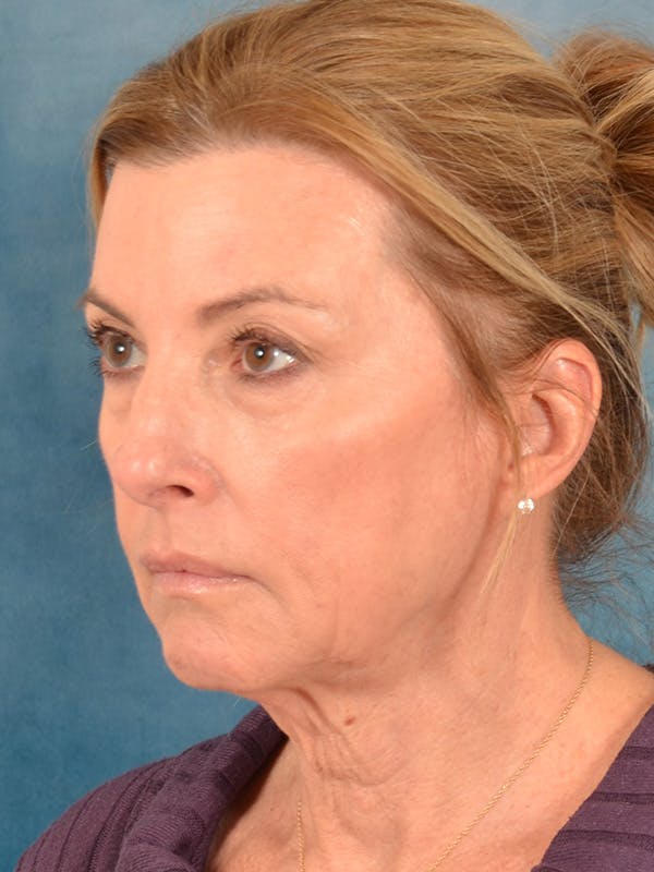 Laser Skin Resurfacing Before & After Gallery - Patient 180127 - Image 3