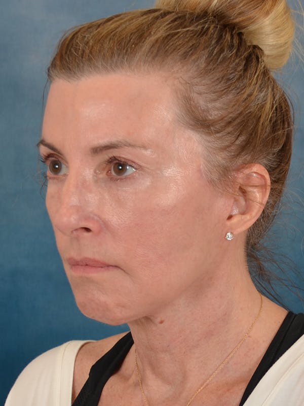 Laser Skin Resurfacing Before & After Gallery - Patient 180127 - Image 4