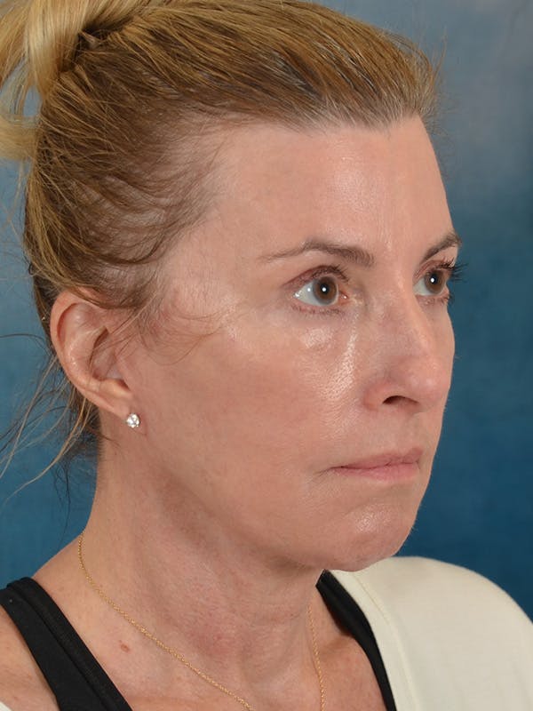 Laser Skin Resurfacing Before & After Gallery - Patient 180127 - Image 6