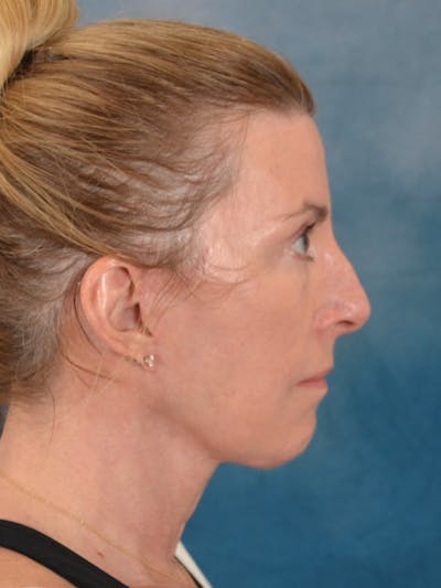 Laser Skin Resurfacing Before & After Gallery - Patient 180127 - Image 8