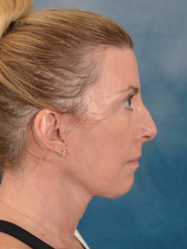 Laser Skin Resurfacing Before & After Gallery - Patient 180127 - Image 8