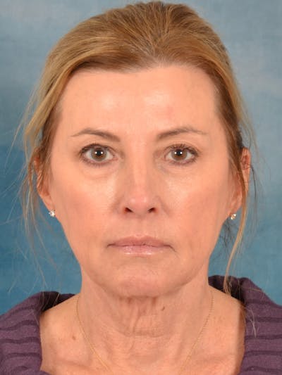 Laser Skin Resurfacing Before & After Gallery - Patient 180127 - Image 1