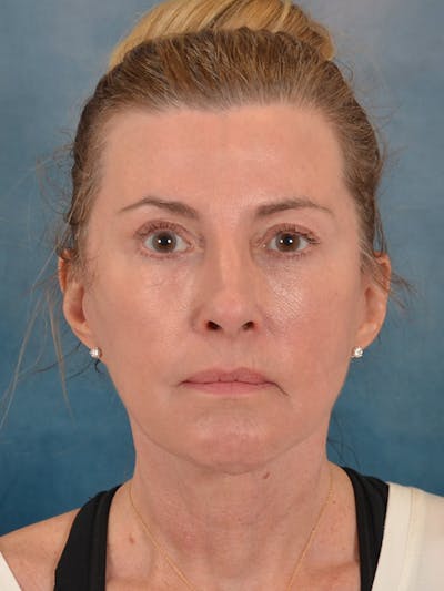 Laser Skin Resurfacing Before & After Gallery - Patient 180127 - Image 2
