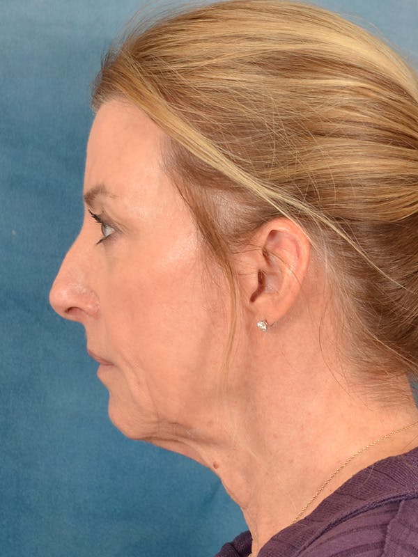 Laser Skin Resurfacing Before & After Gallery - Patient 180127 - Image 9