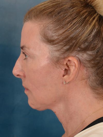 Laser Skin Resurfacing Before & After Gallery - Patient 180127 - Image 10