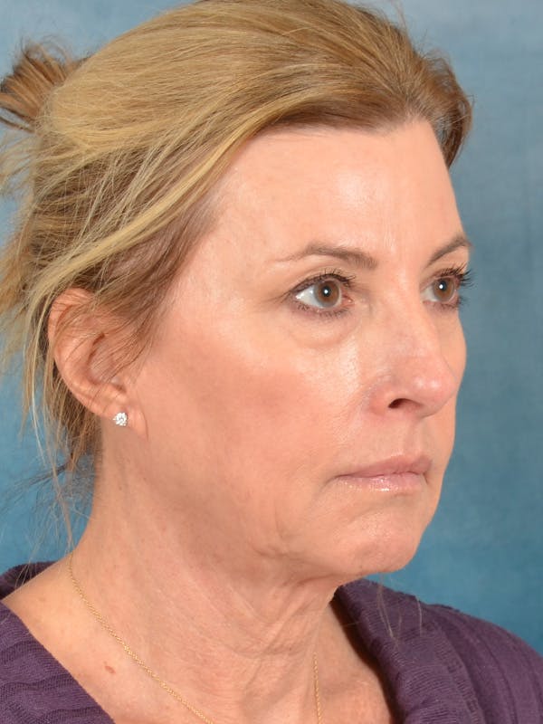 Laser Skin Resurfacing Before & After Gallery - Patient 180127 - Image 5
