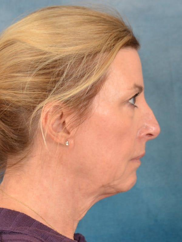 Laser Skin Resurfacing Before & After Gallery - Patient 180127 - Image 7