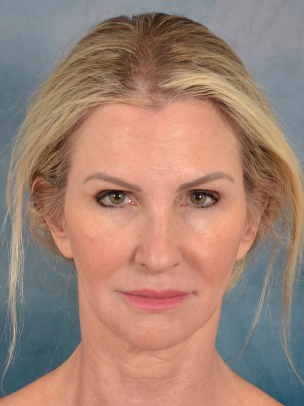 Rhinoplasty Before & After Gallery - Patient 603359 - Image 5