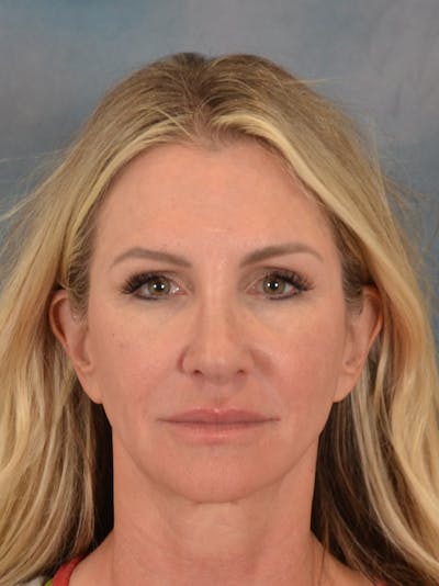 Rhinoplasty Before & After Gallery - Patient 603359 - Image 6