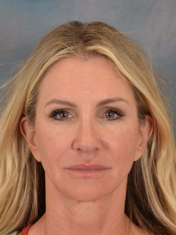 Rhinoplasty Before & After Gallery - Patient 603359 - Image 6