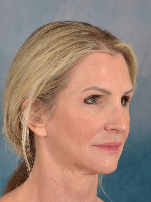 Rhinoplasty Before & After Gallery - Patient 603359 - Image 7