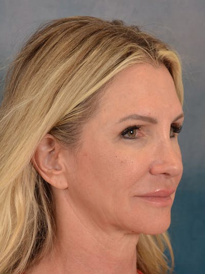Rhinoplasty Before & After Gallery - Patient 603359 - Image 8