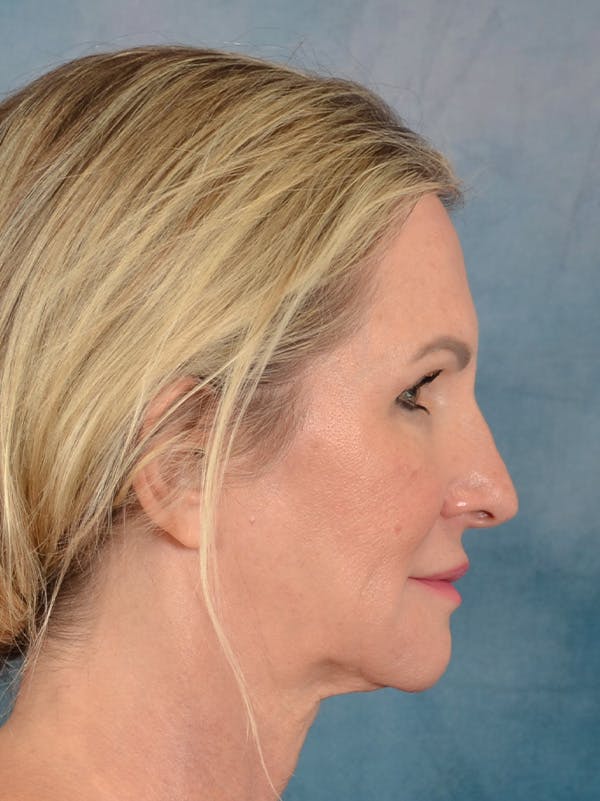 Rhinoplasty Before & After Gallery - Patient 603359 - Image 9