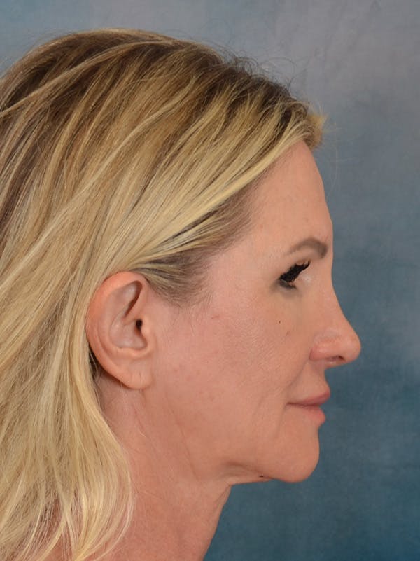 Rhinoplasty Before & After Gallery - Patient 603359 - Image 10