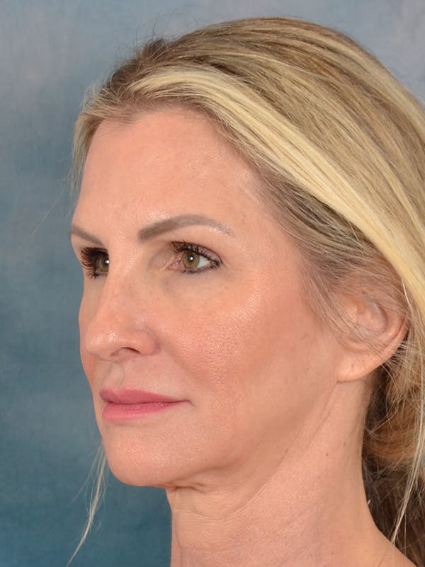 Rhinoplasty Before & After Gallery - Patient 603359 - Image 3